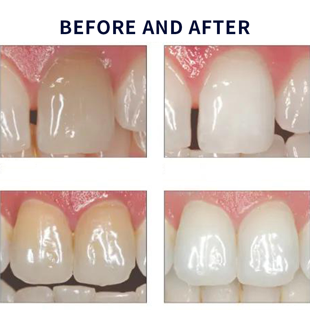 Opalescence Whitening 20% PF 2 - Teeth Whitening Gel Peroxide ulasan dan harga