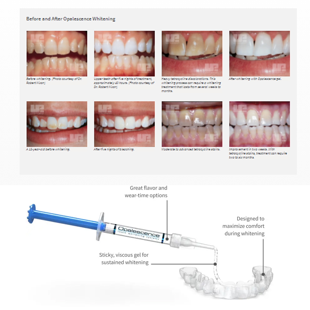 Opalescence Whitening 20% PF 2 - Teeth Whitening Gel Peroxide ulasan dan harga