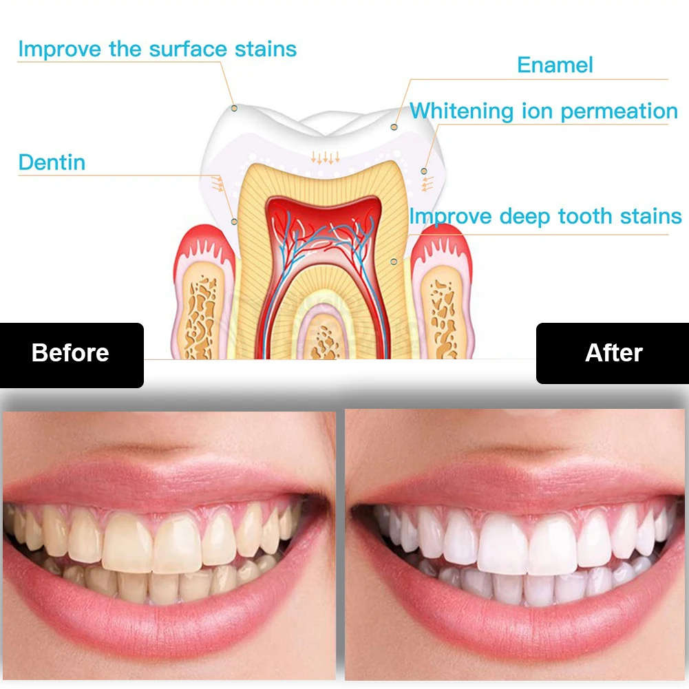 Dental Teeth Whitening Kit Min - Whitening Pen Bleach ulasan dan harga